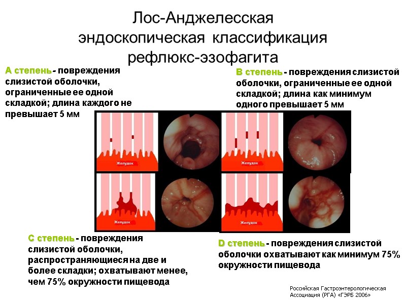 Лос-Анджелесская эндоскопическая классификация рефлюкс-эзофагита А степень - повреждения слизистой оболочки, ограниченные ее одной складкой;